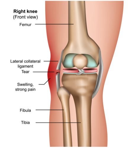 Posterolateral-Corner-Injury