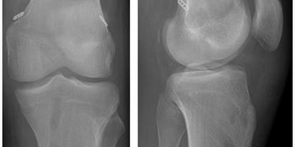 Radiographs-after-simultaneous-ACL-and-PCL-reconstruction